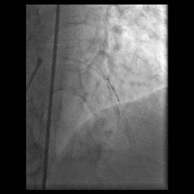 stent in place 2000