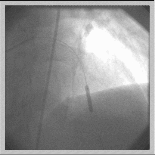 Stent in Place 2000